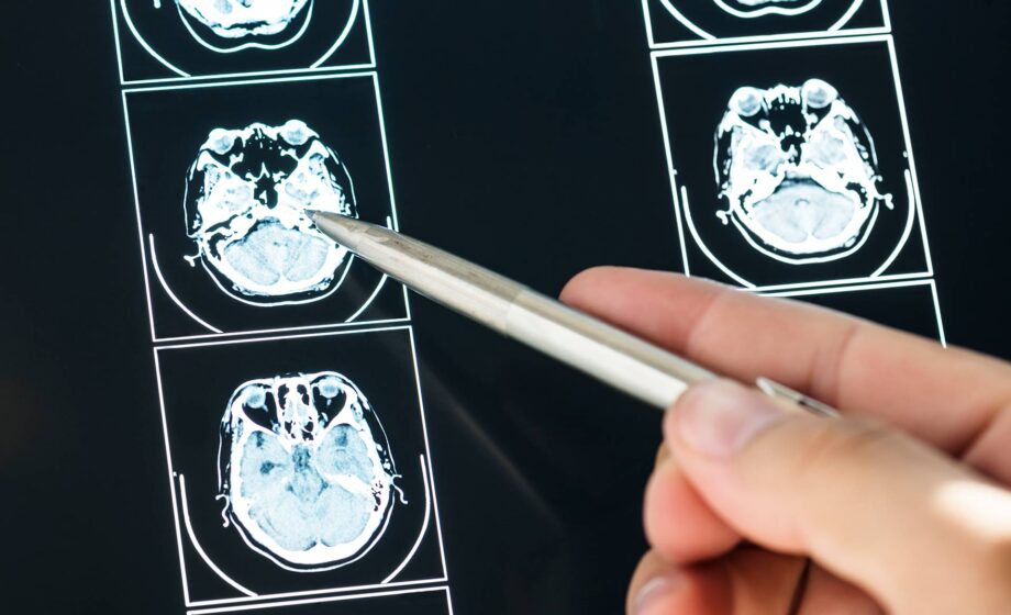 Speranza di cura Glioblastoma