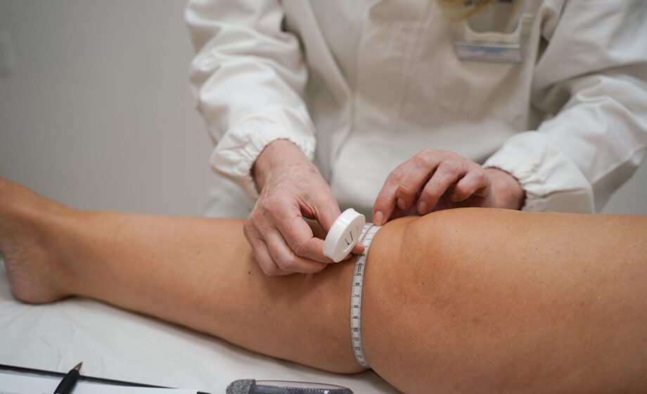 Lipedema