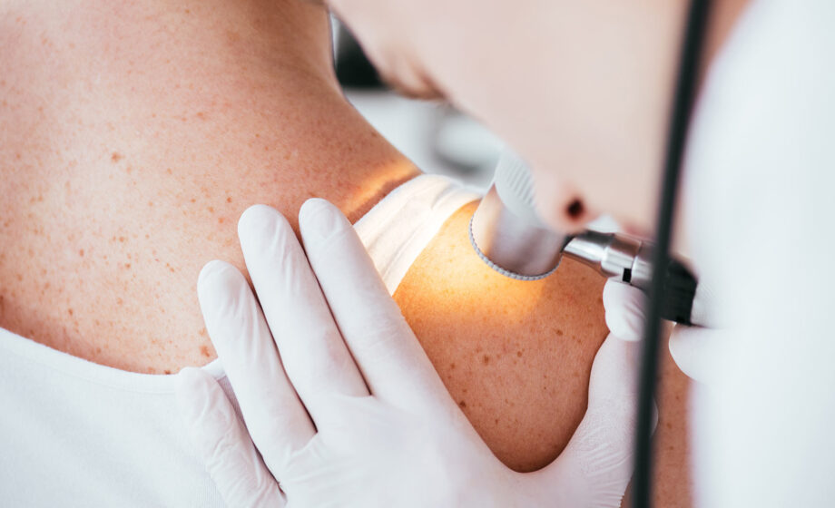 piccoli punti melanoma