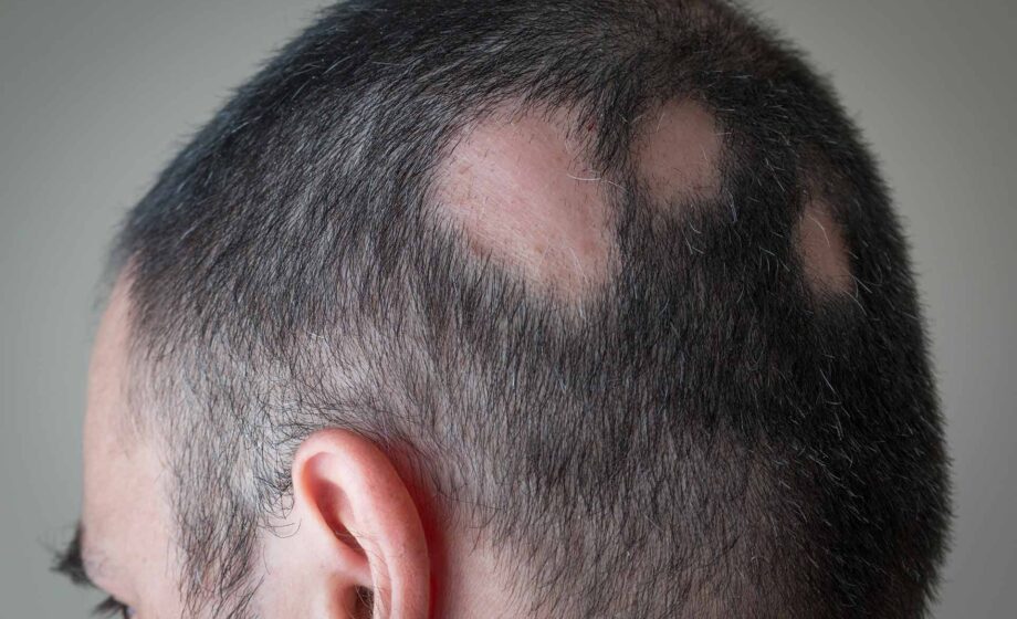 alopecia