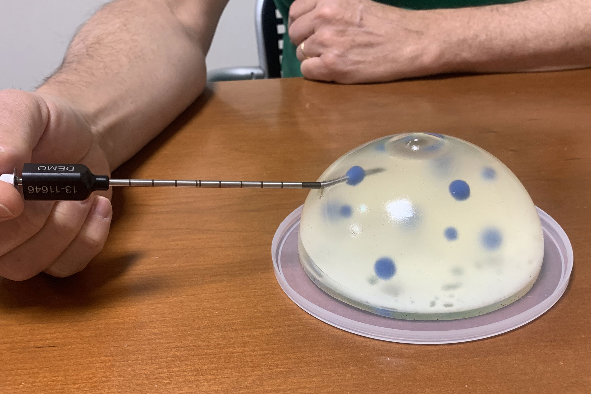 Una criosonda mentre tratta il tumore al seno