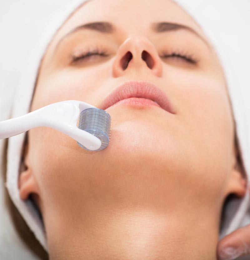 Una donna mentre si sta sottoponendo ad un trattamento di ringiovanimento del viso con tecnica needling