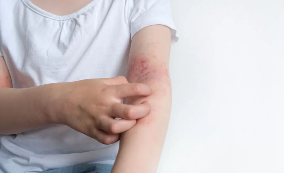 Persona con dermatite atopica e prurigo nodularis